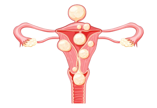 Uterine Fibroids