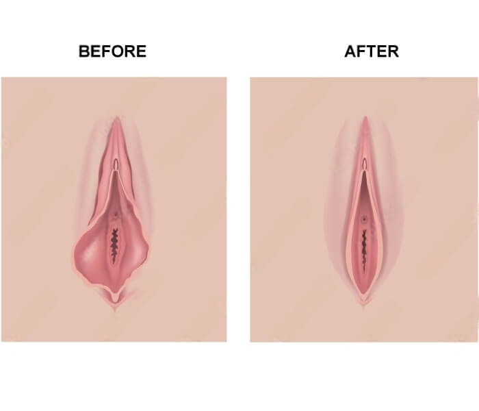 Before and After Vaginal Rejuvenation - Eastcoastobgyn