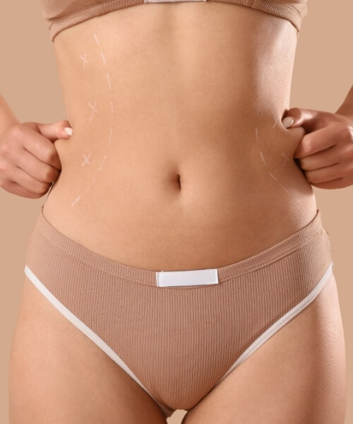 Abdominoplasty